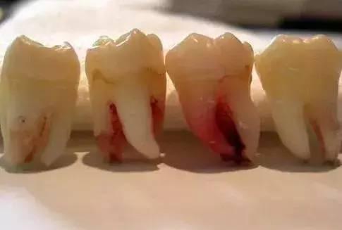 拔了智齿可以吃哈密瓜不,哈密瓜成禁忌？揭秘恢复期饮食注意事项